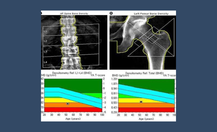 moc dexa osteoporosi