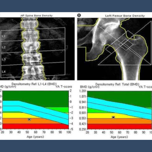 moc dexa osteoporosi